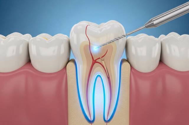 Root Canal Treatment